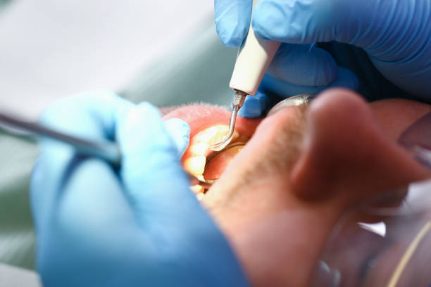 Best Dental Abscess Treatment in Atlanta, TX