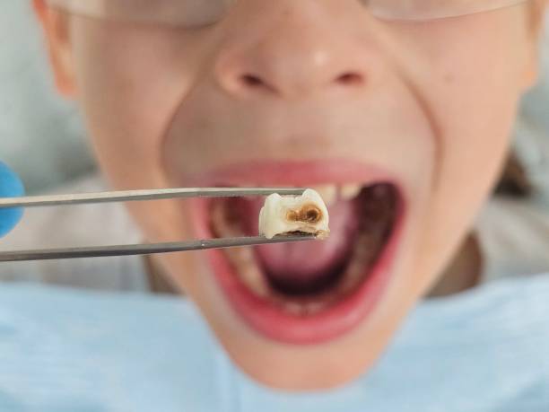 Best Emergency Treatment for Oral Infections in Atlanta, TX